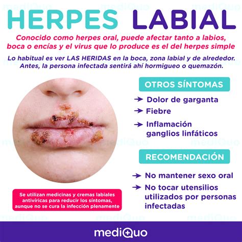 síntomas de herpes labial-1